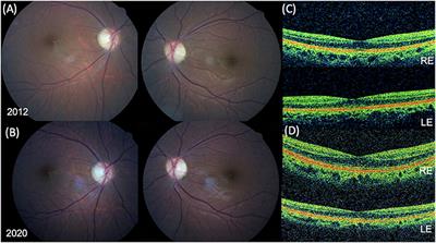 Case Report: Ophthalmologic Evaluation Over a Long Follow-Up Time in a Patient With Wolfram Syndrome Type 2: Slowly Progressive Optic Neuropathy as a Possible Clinical Finding